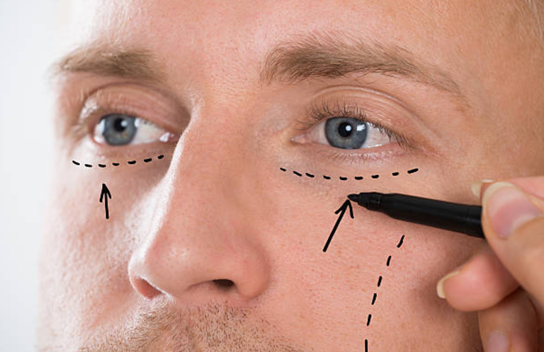 PLASTIC SURGERY FOR MEN - Eye Bag Removal