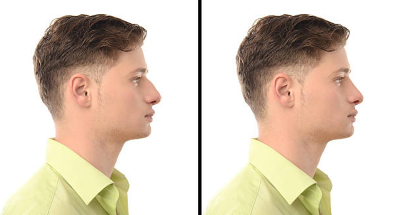 PLASTIC SURGERY FOR MEN - Rhinoplasty - Nose reshaping