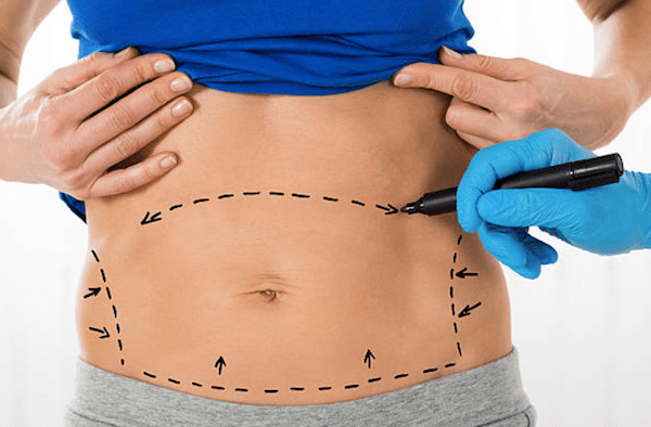 PLASTIC SURGERY FOR WOMEN - 2 -Women Tummy Tuck