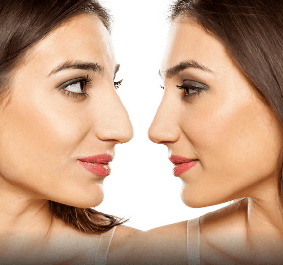 PLASTIC SURGERY FOR WOMEN - Rhinoplasty - Nose reshaping