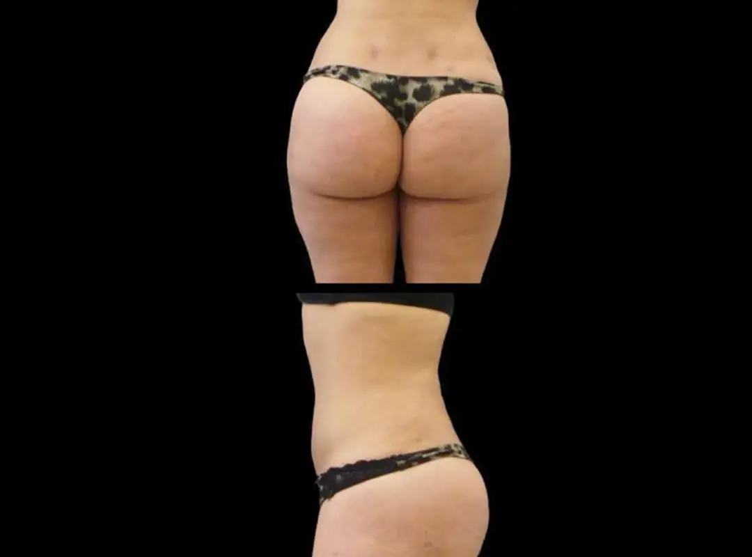 360 Liposuction After