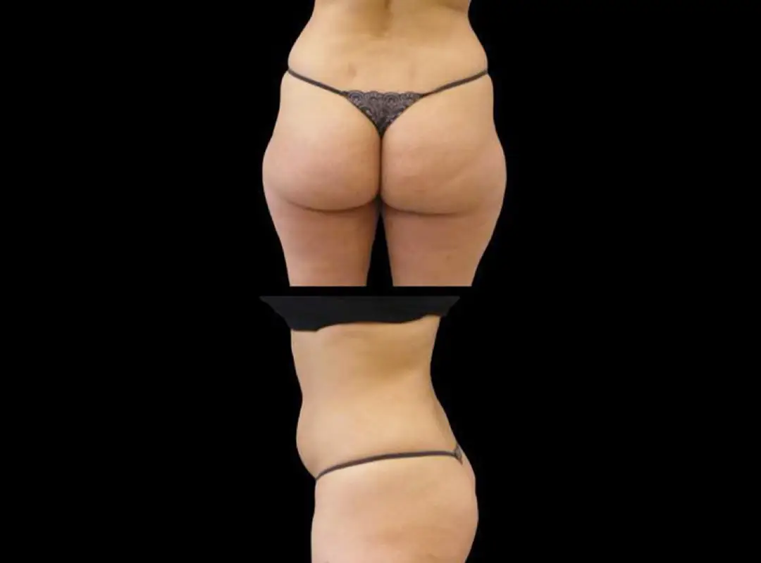 360 Liposuction Before