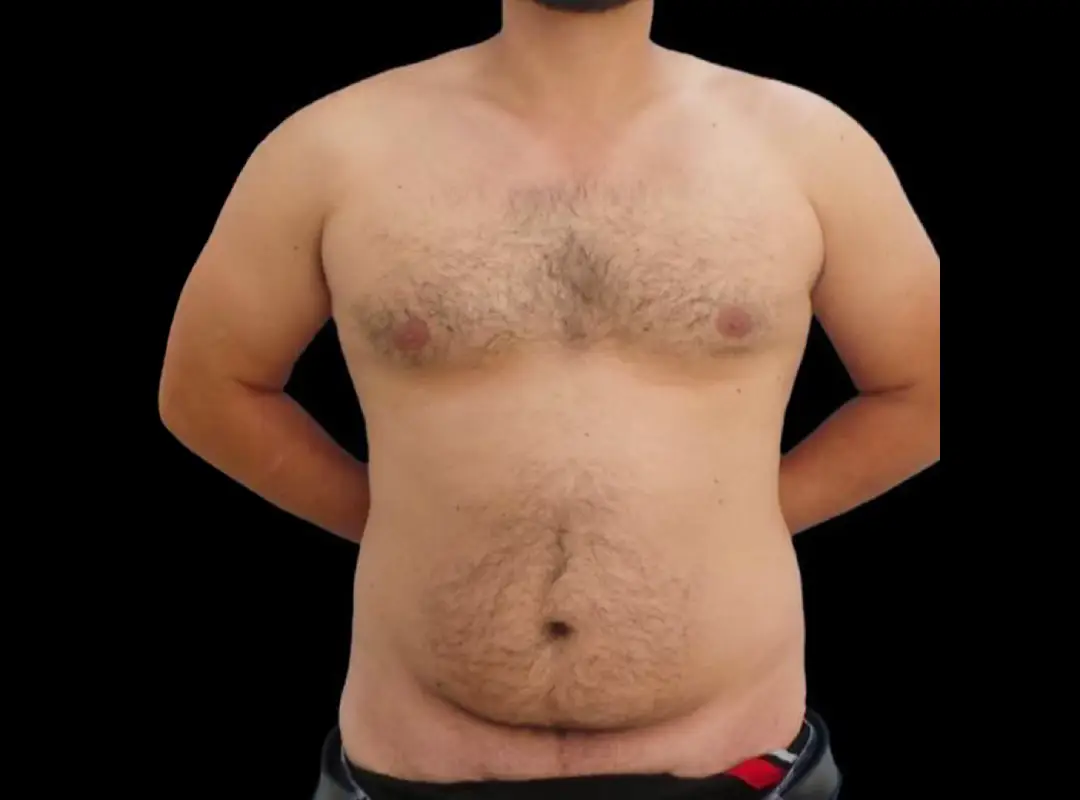 Abdominal Liposuction Before