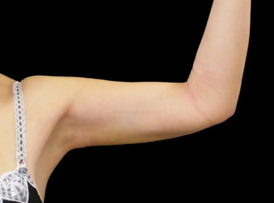 Arm Liposuction After