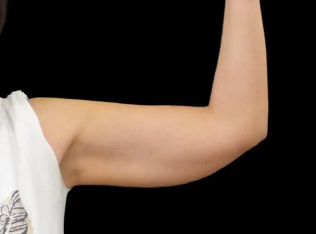 Arm Liposuction Before