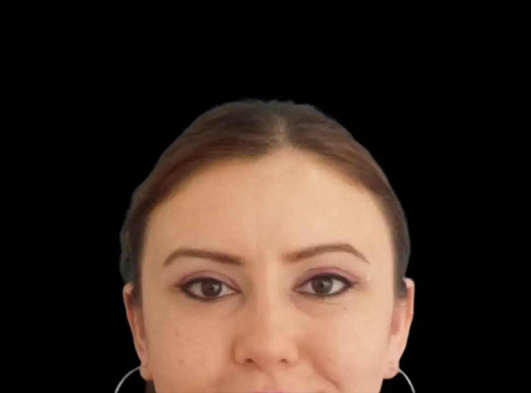 Blepharoplasty After