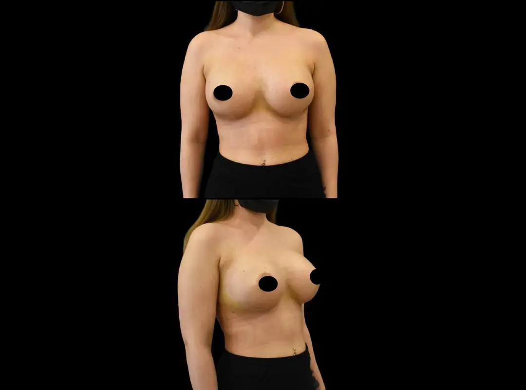 Breast Augmentation After