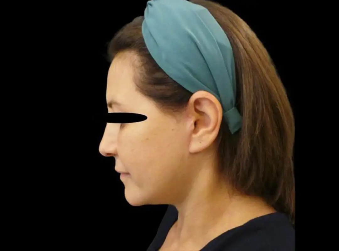 Face & Neck Lift After