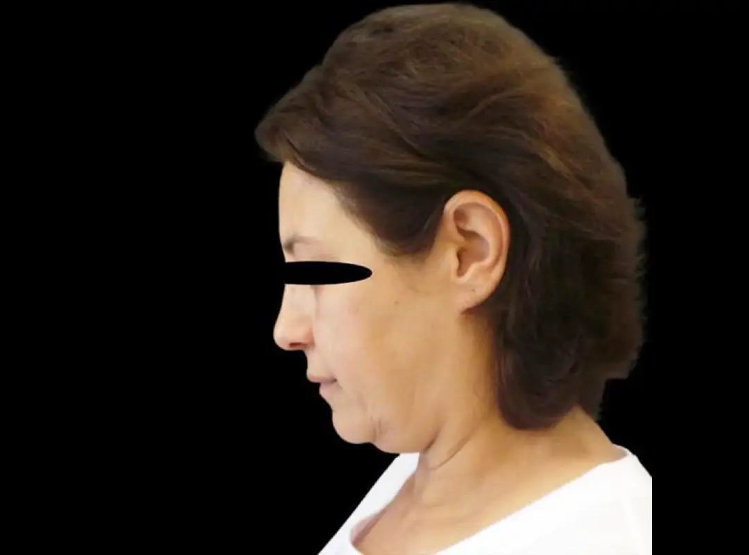 Face & Neck Lift Before