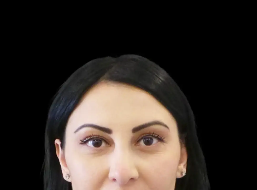 Lower Eyelid Surgery After