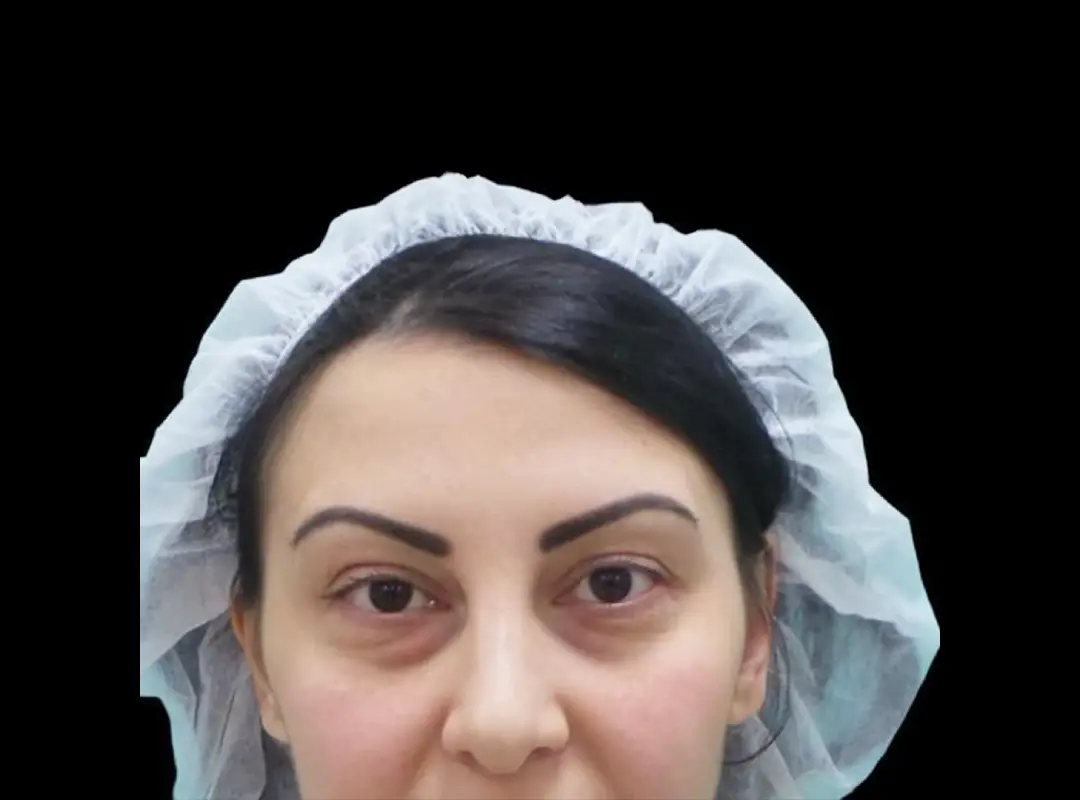 Lower Eyelid Surgery Before