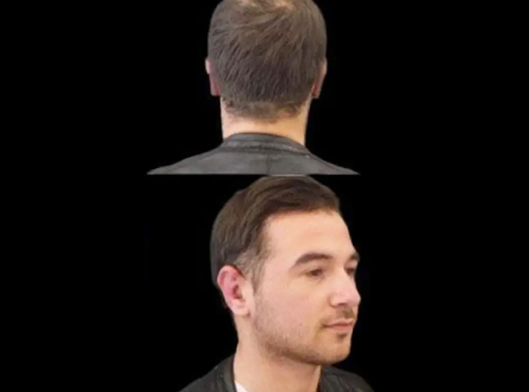 Prominent Ear Correction After