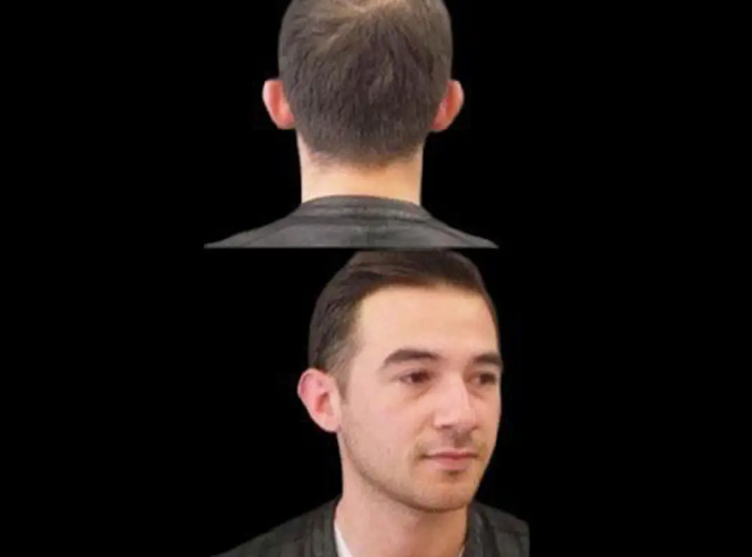 Prominent Ear Correction Before