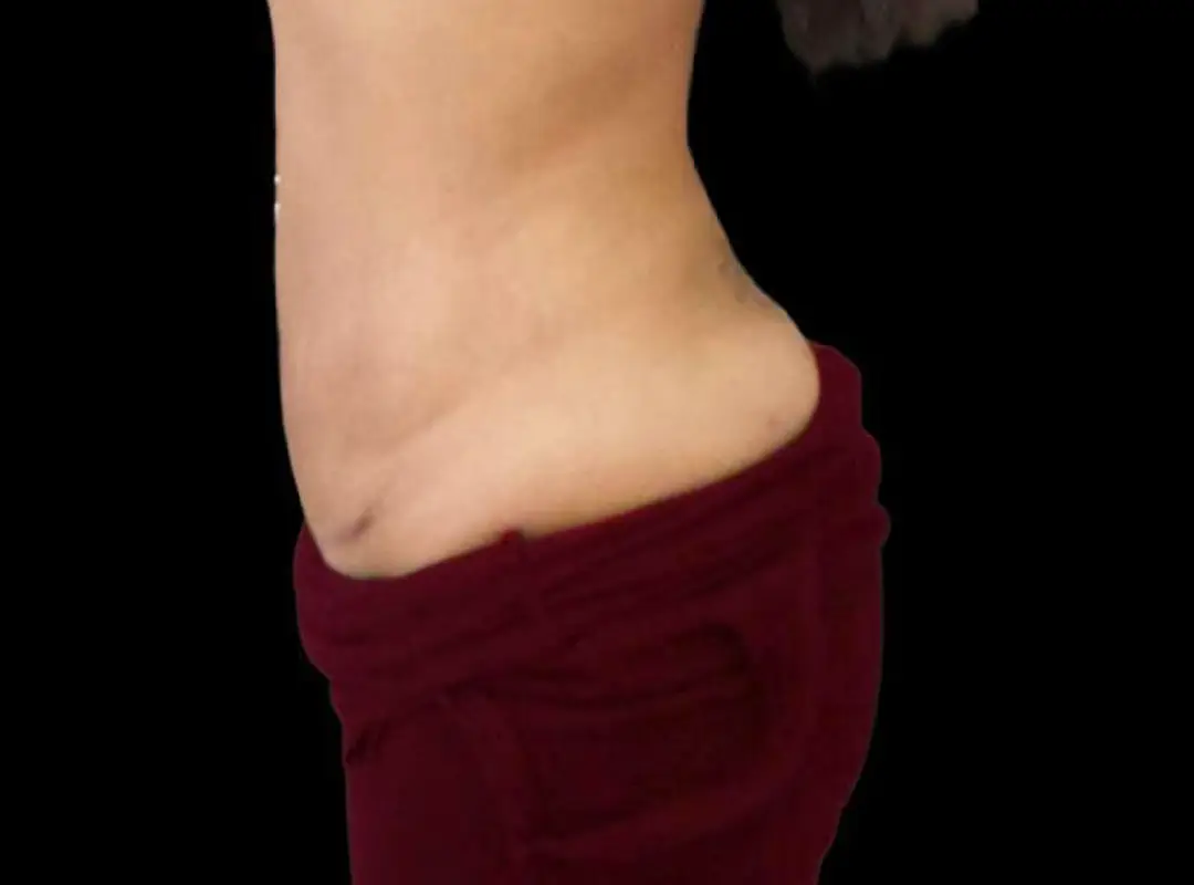 Tummy Tuck After